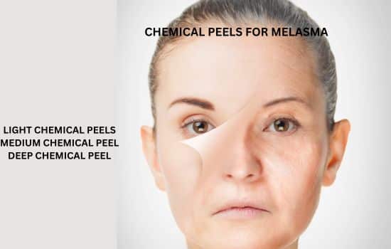 chemical peels used for melasma