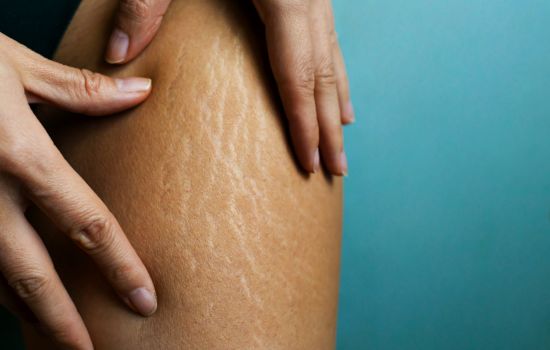 weight loss, stretch marks