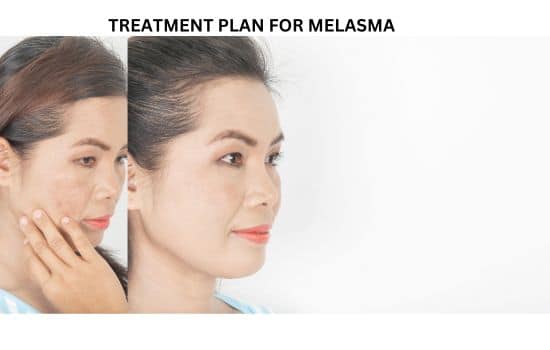 TREATMENT PLAN FOR MELASMA