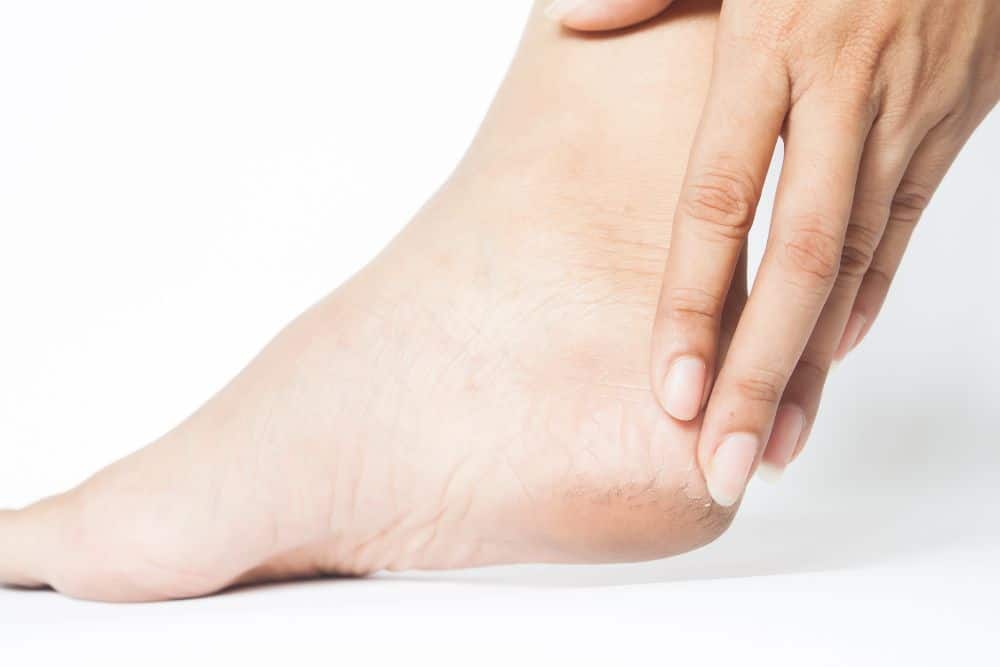 How to treat cracked heels overnight