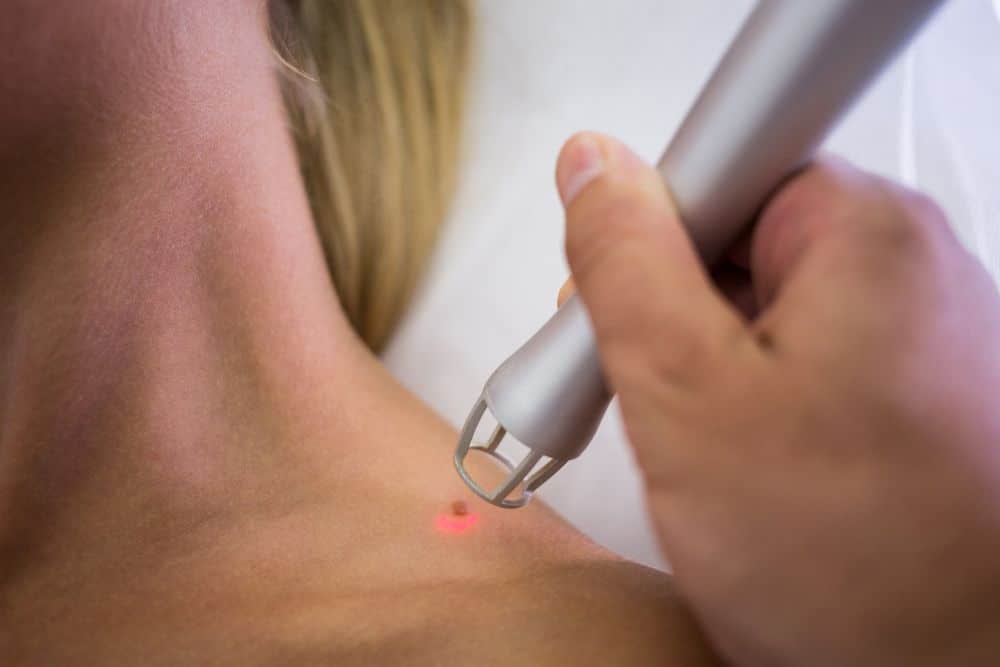 laser mole removal