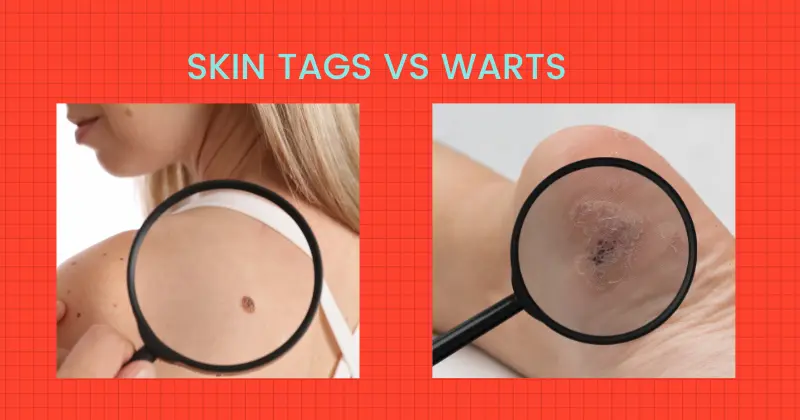 Skin Tags vs Warts