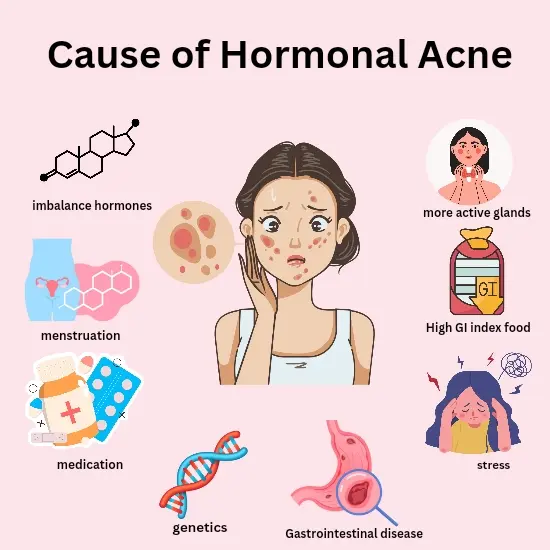 Causes of Hormonal Acne