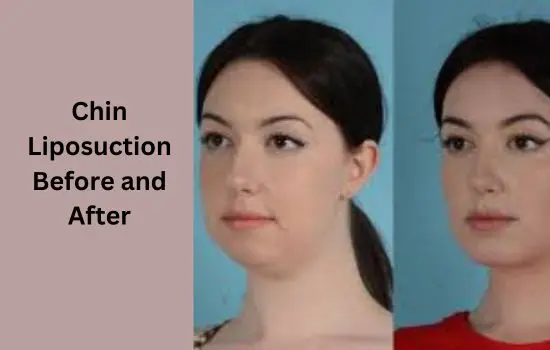 chin liposuction before and after