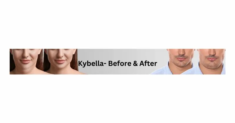 Kybella - before and after results.