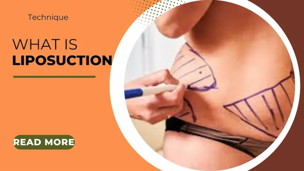 what is liposuction