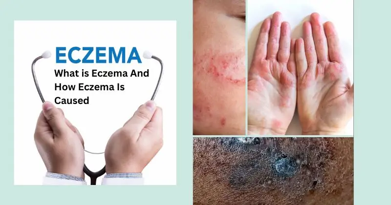 What is Eczema And How Eczema Is Caused