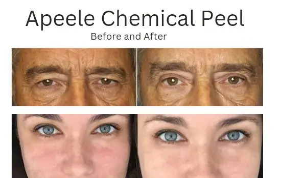 Apeele chemical peel before and after