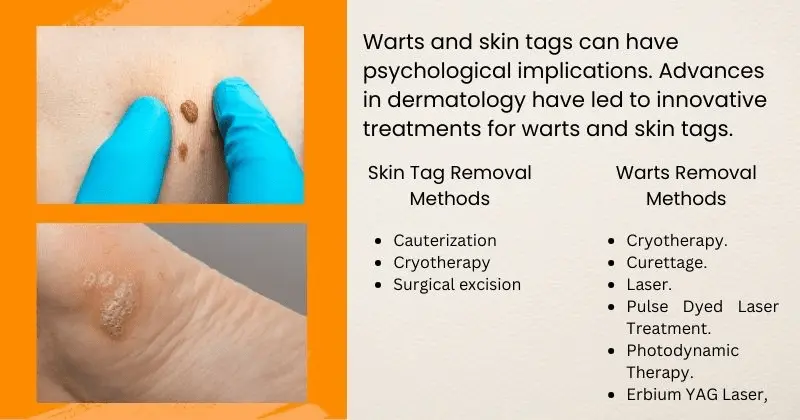 skin tags vs. skin warts - removal method